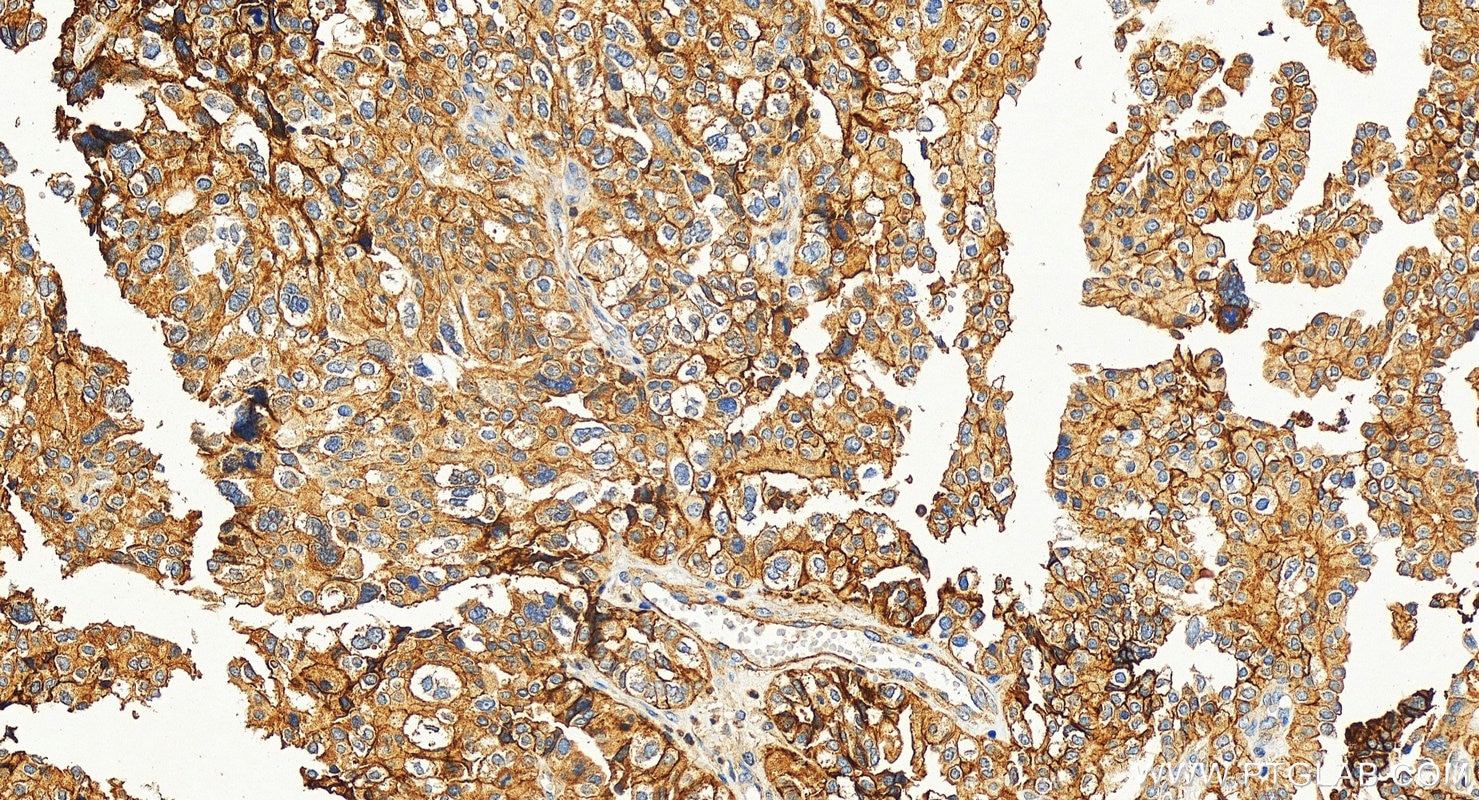 Immunohistochemistry (IHC) staining of human ovary tumor tissue using CD151 Polyclonal antibody (27816-1-AP)