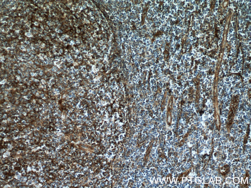 Immunohistochemistry (IHC) staining of human tonsillitis tissue using CD151 Monoclonal antibody (66567-1-Ig)