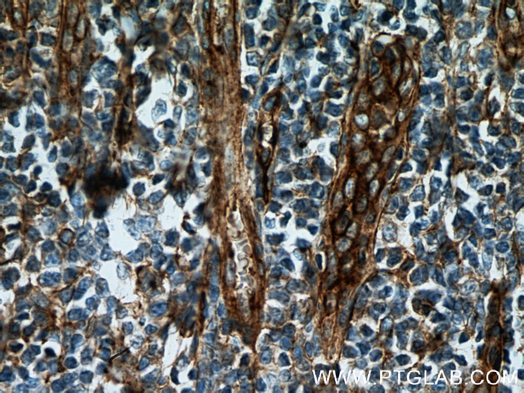 Immunohistochemistry (IHC) staining of human tonsillitis tissue using CD151 Monoclonal antibody (66567-1-Ig)