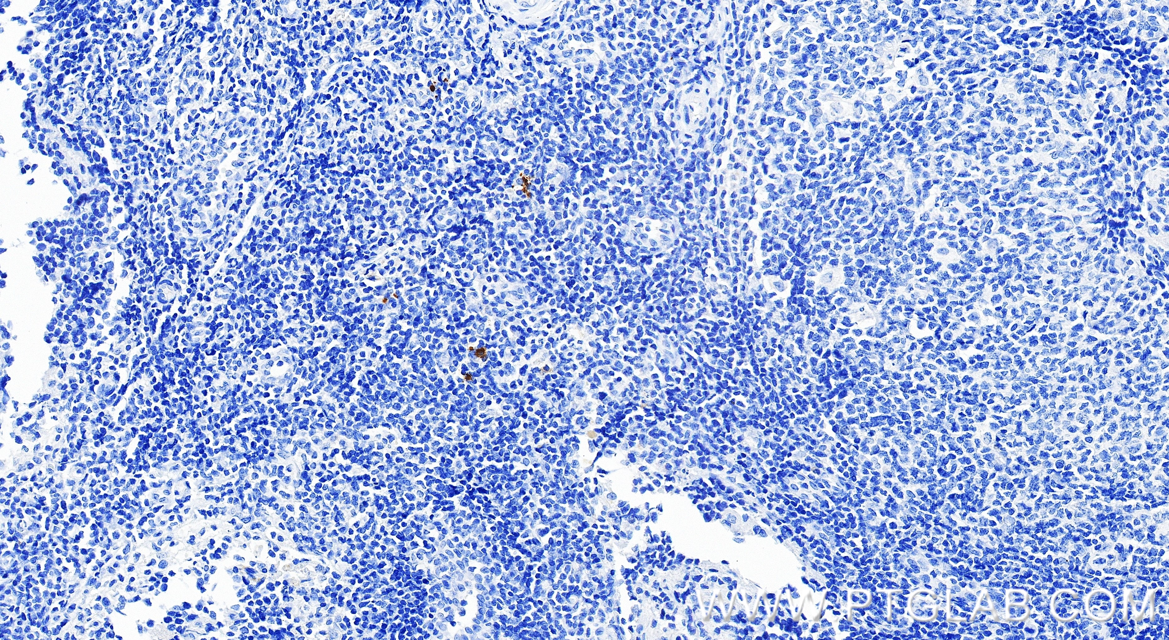 IHC staining of human tonsillitis using 98628-1-RR Immunohistochemistry (IHC) staining of human tonsillitis tissue using Anti-Human CD158Z/KIR3DL3 Rabbit Recombinant Antib (98628-1-RR)