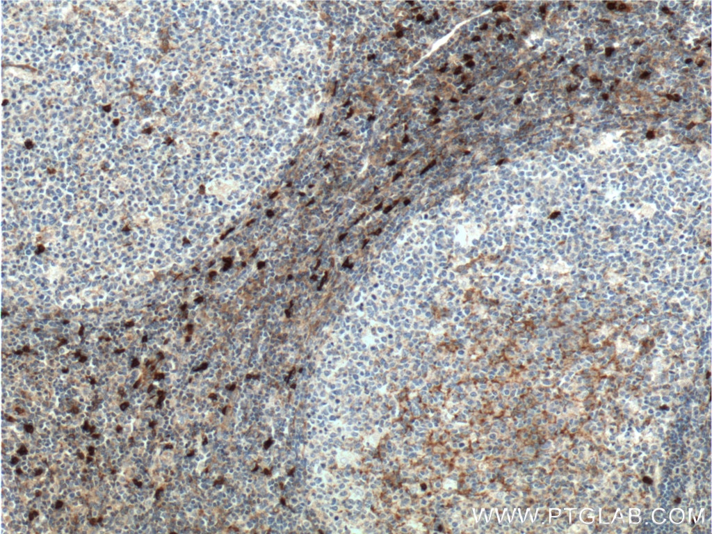 IHC staining of human tonsillitis using 16559-1-AP