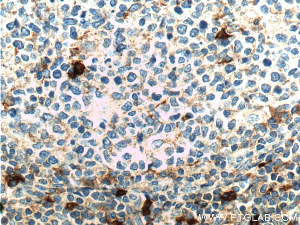 IHC staining of human tonsillitis using 16559-1-AP