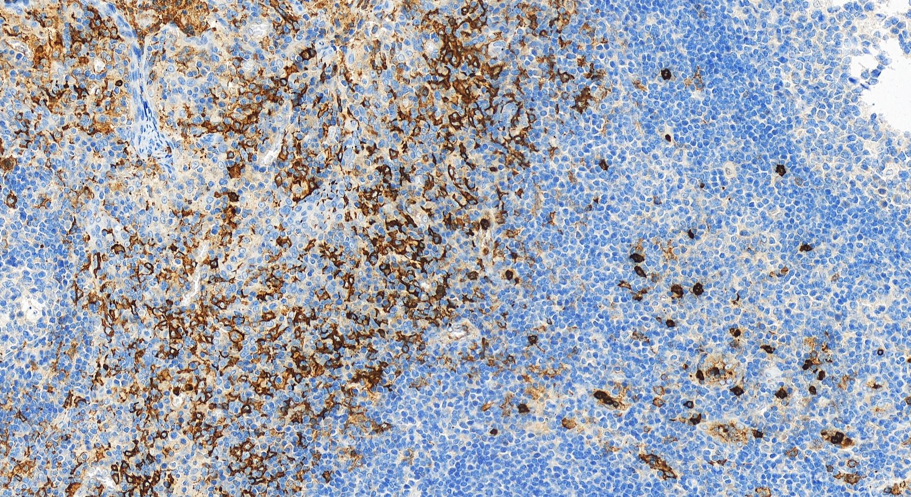 Immunohistochemistry (IHC) staining of human tonsillitis tissue using CD16 Polyclonal antibody (30567-1-AP)