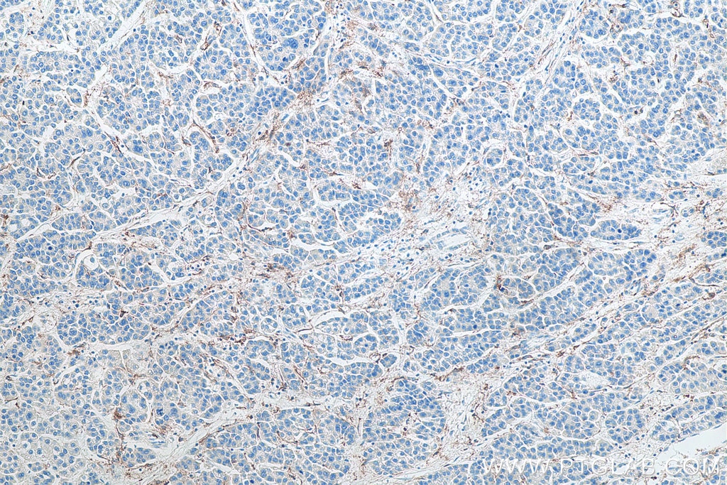 Immunohistochemistry (IHC) staining of human liver cancer tissue using CD16 Monoclonal antibody (66779-1-Ig)
