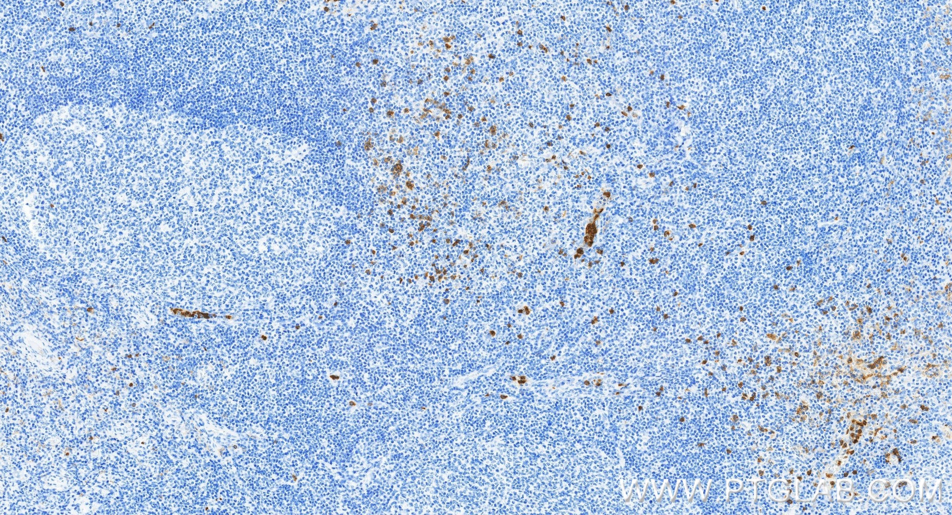 Immunohistochemistry (IHC) staining of human tonsillitis tissue using CD16 Recombinant monoclonal antibody (83110-2-RR)