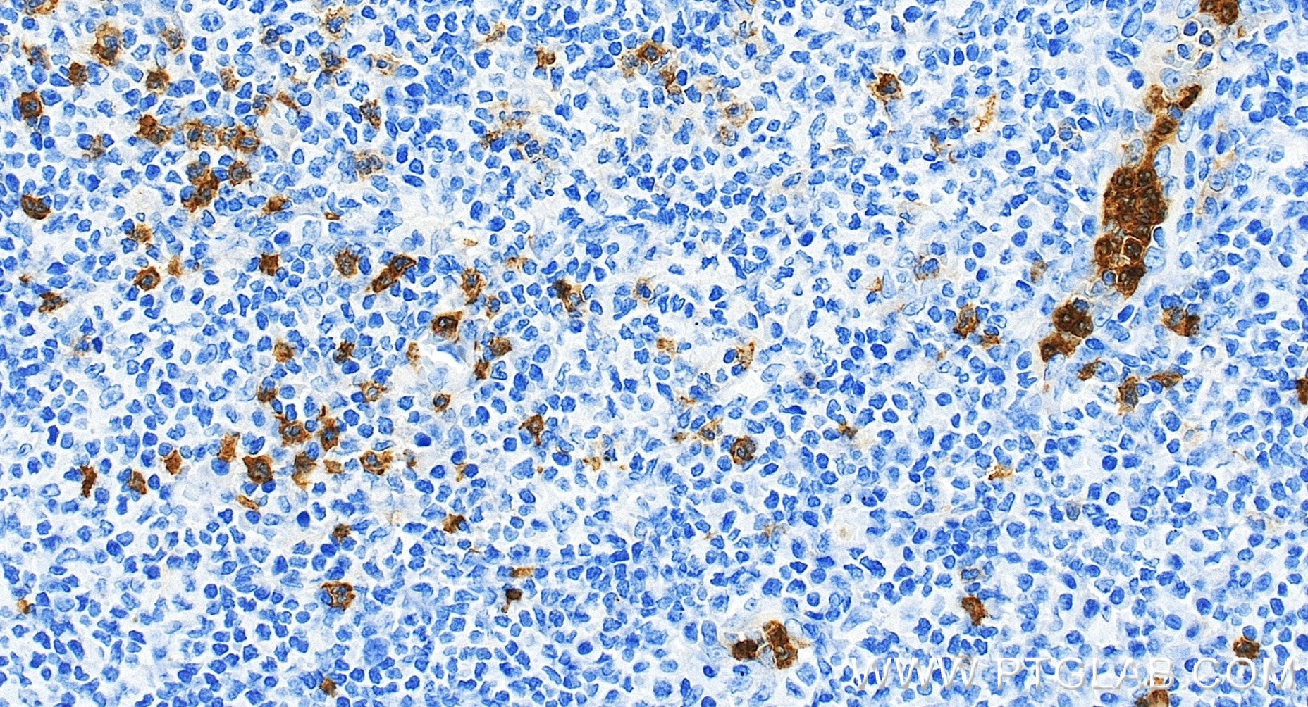 Immunohistochemistry (IHC) staining of human tonsillitis tissue using CD16 Recombinant monoclonal antibody (83110-2-RR)