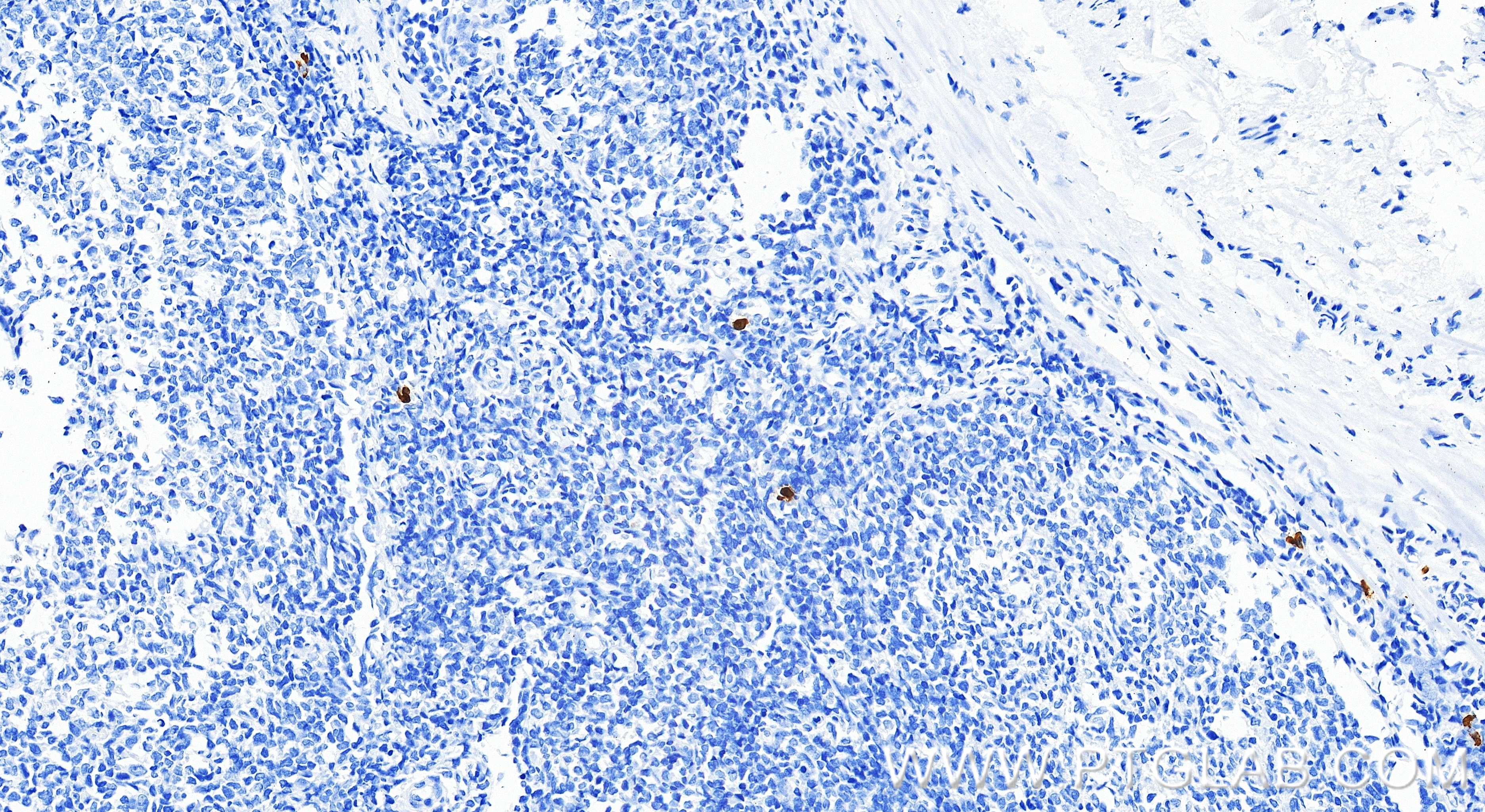 IHC staining of human tonsillitis using 98111-1-RR Immunohistochemistry (IHC) staining of human tonsillitis tissue using Anti-Human CD160 Rabbit Recombinant Antibody (98111-1-RR)