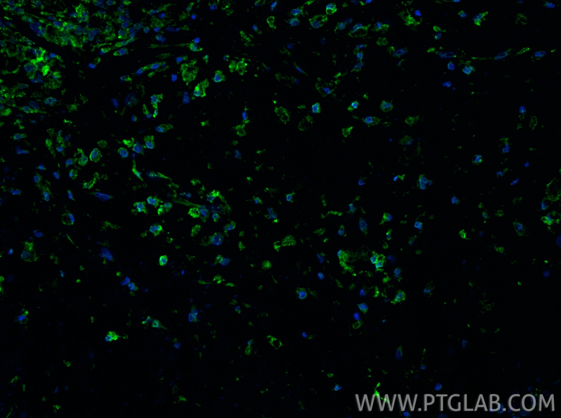 Immunofluorescence (IF) / fluorescent staining of human lung cancer tissue using CD163 Polyclonal antibody (16646-1-AP)