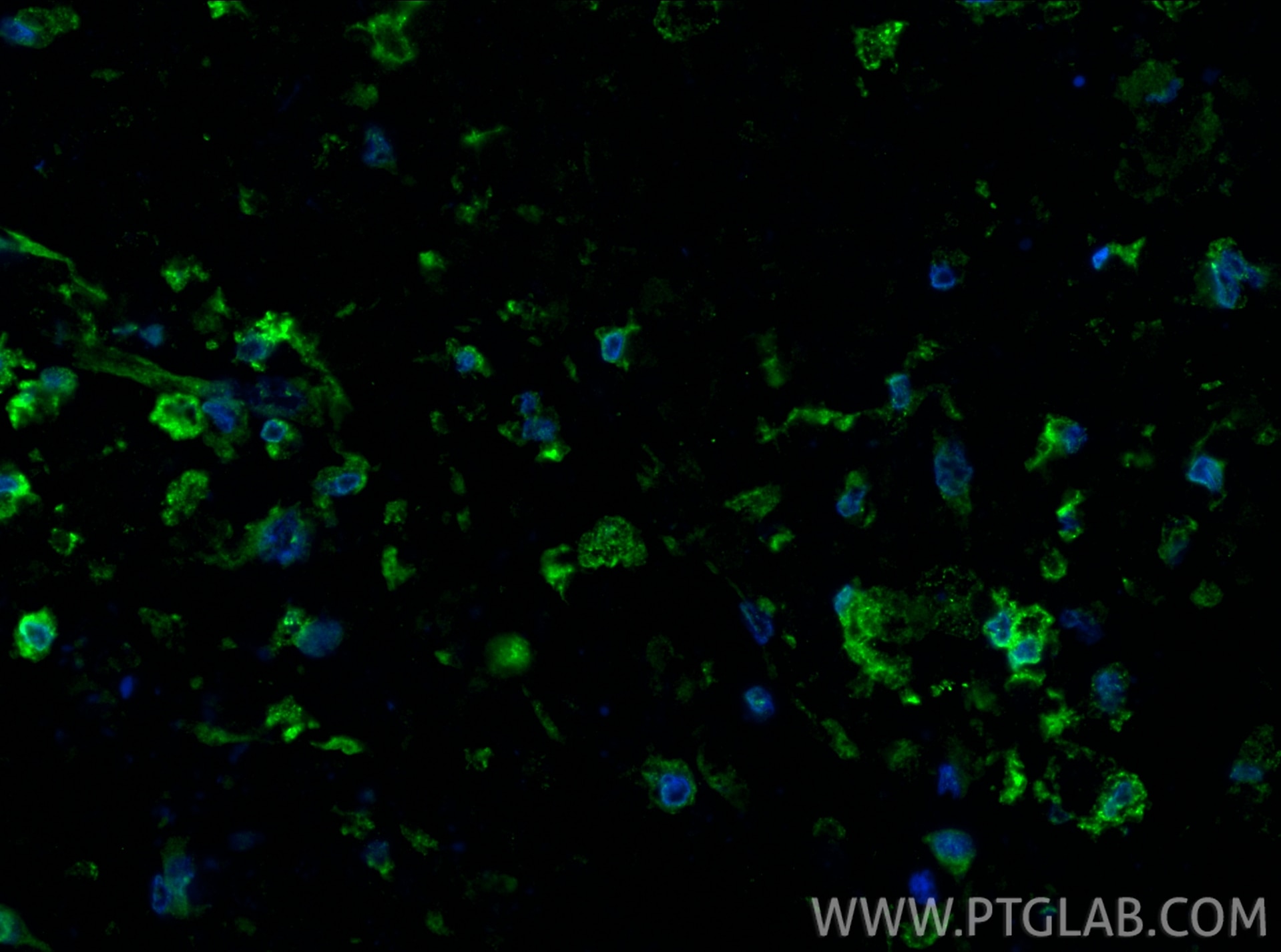 Immunofluorescence (IF) / fluorescent staining of human lung cancer tissue using CD163 Polyclonal antibody (16646-1-AP)