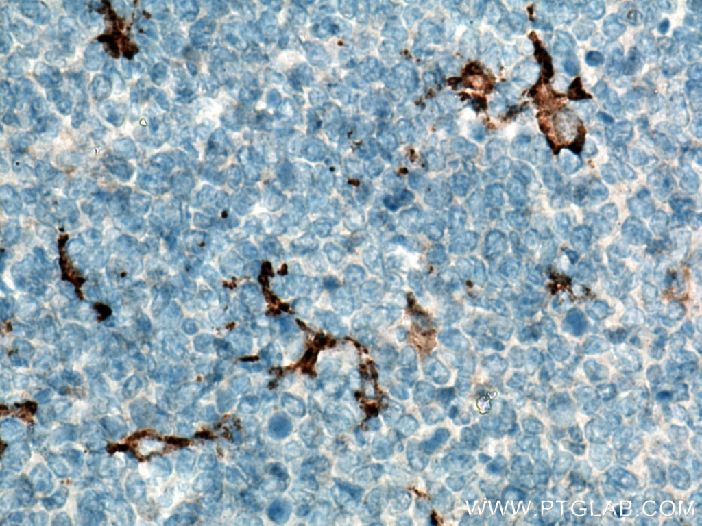 Immunohistochemistry (IHC) staining of human tonsillitis tissue using CD163 Polyclonal antibody (16646-1-AP)