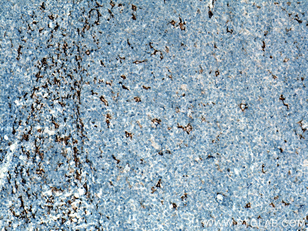 Immunohistochemistry (IHC) staining of human tonsillitis tissue using CD163 Polyclonal antibody (16646-1-AP)