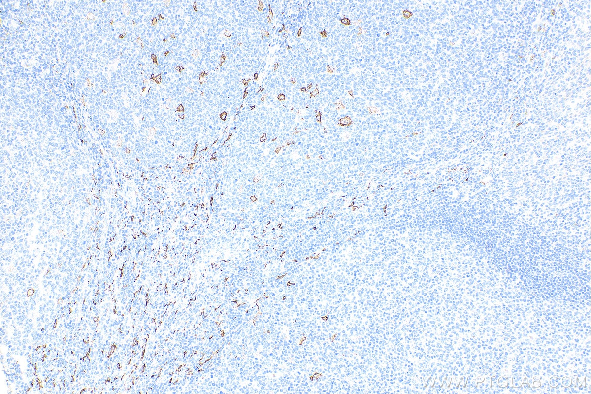 Immunohistochemistry (IHC) staining of human tonsillitis tissue using CD163 Monoclonal antibody (68218-1-Ig)