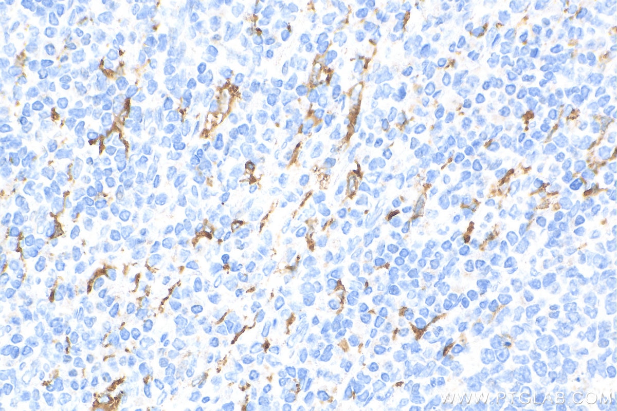 Immunohistochemistry (IHC) staining of human tonsillitis tissue using CD163 Monoclonal antibody (68218-1-Ig)