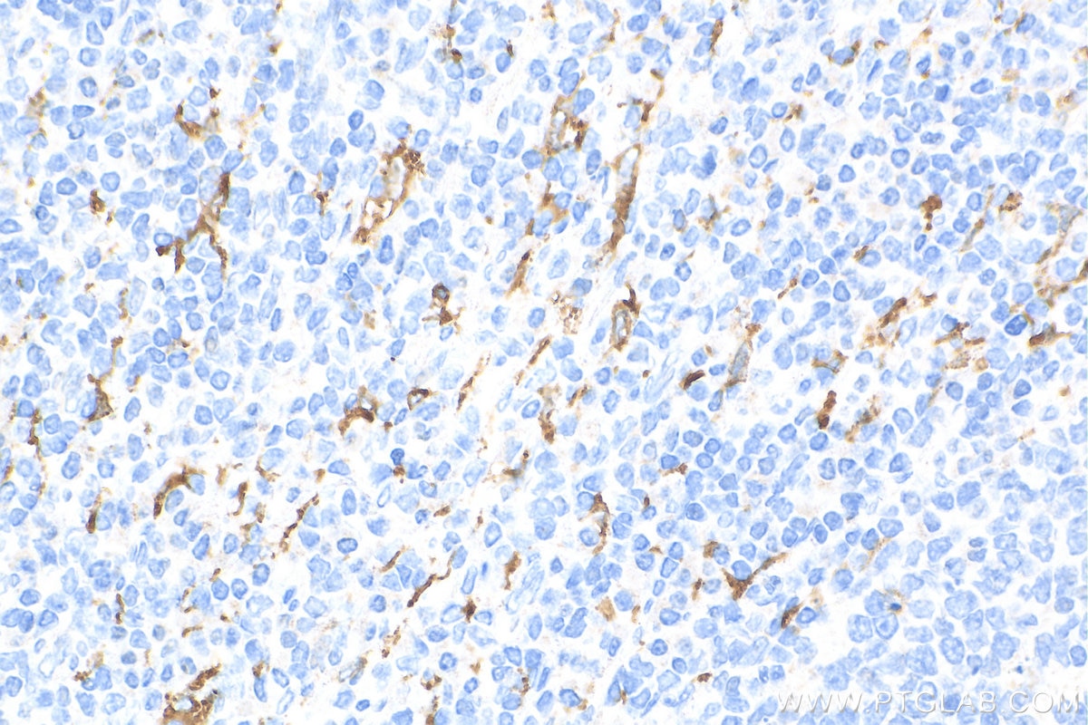 IHC staining of human tonsillitis using 68218-1-Ig