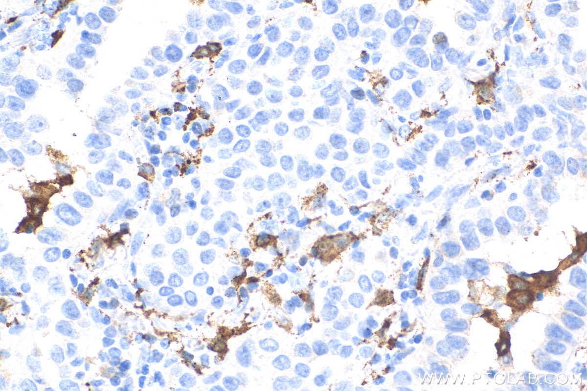 Immunohistochemistry (IHC) staining of human lung cancer tissue using CD163 Monoclonal antibody (68218-1-Ig)