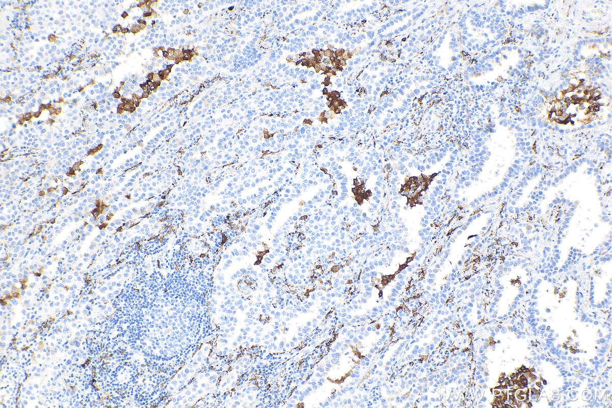 Immunohistochemistry (IHC) staining of human lung cancer tissue using CD163 Monoclonal antibody (68218-1-Ig)