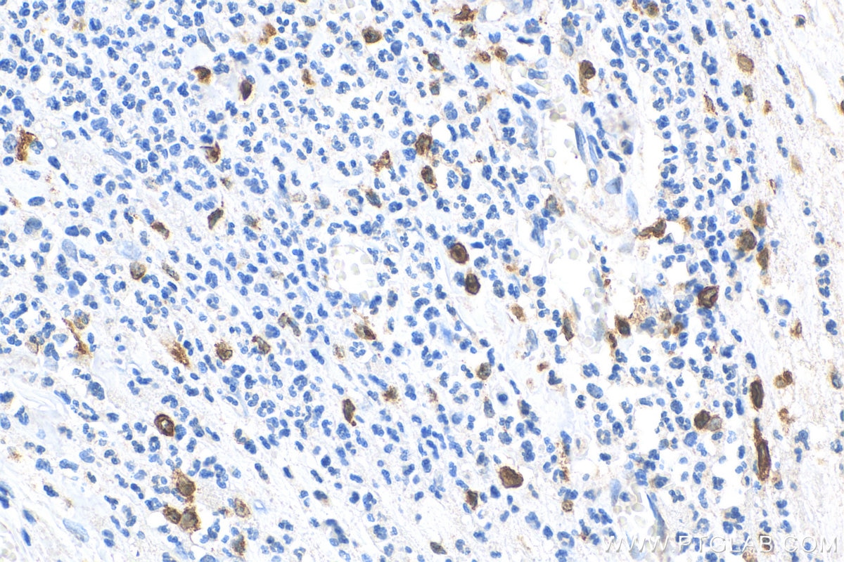 Immunohistochemistry (IHC) staining of human appendicitis tissue using CD163 Monoclonal antibody (68218-1-Ig)