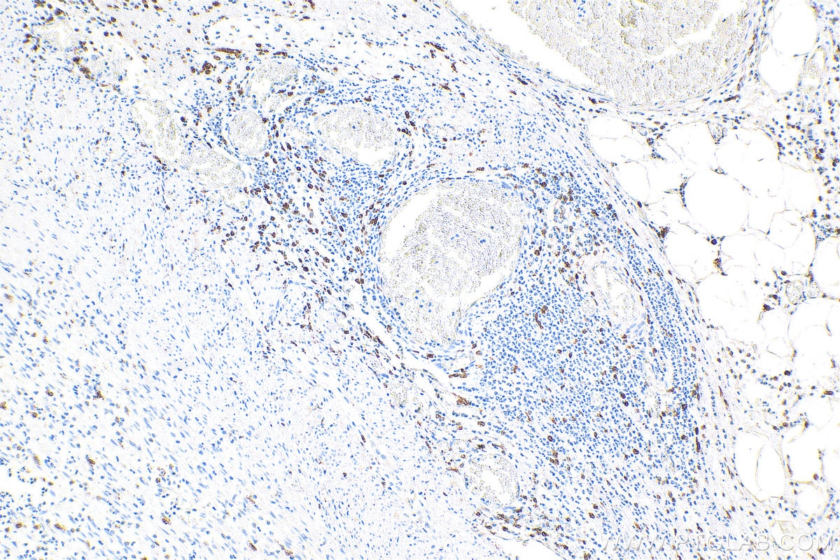 Immunohistochemistry (IHC) staining of human appendicitis tissue using CD163 Monoclonal antibody (68218-1-Ig)