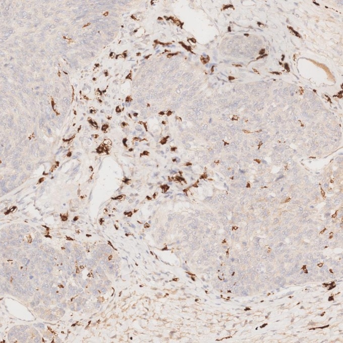 IHC staining of human ovary cancer using 68218-1-Ig Immunohistochemistry (IHC) staining of human ovary cancer tissue using CD163 Monoclonal antibody (68218-1-Ig)