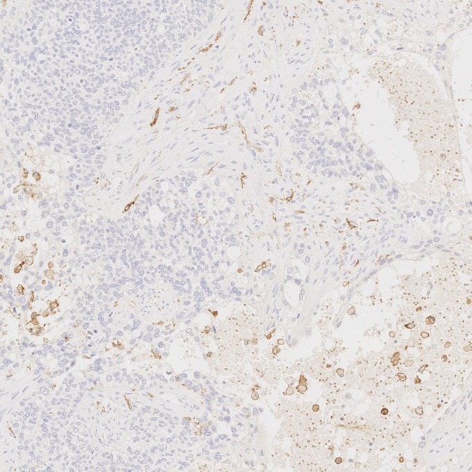 IHC staining of human ovary cancer using 68218-1-Ig Immunohistochemistry (IHC) staining of human ovary cancer tissue using CD163 Monoclonal antibody (68218-1-Ig)