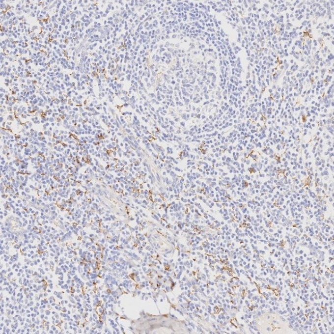 IHC staining of human tonsillitis using 68218-1-Ig Immunohistochemistry (IHC) staining of human tonsillitis tissue using CD163 Monoclonal antibody (68218-1-Ig)