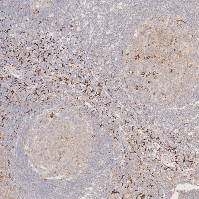 IHC staining of human tonsillitis using 68218-1-Ig Immunohistochemistry (IHC) staining of human tonsillitis tissue using CD163 Monoclonal antibody (68218-1-Ig)