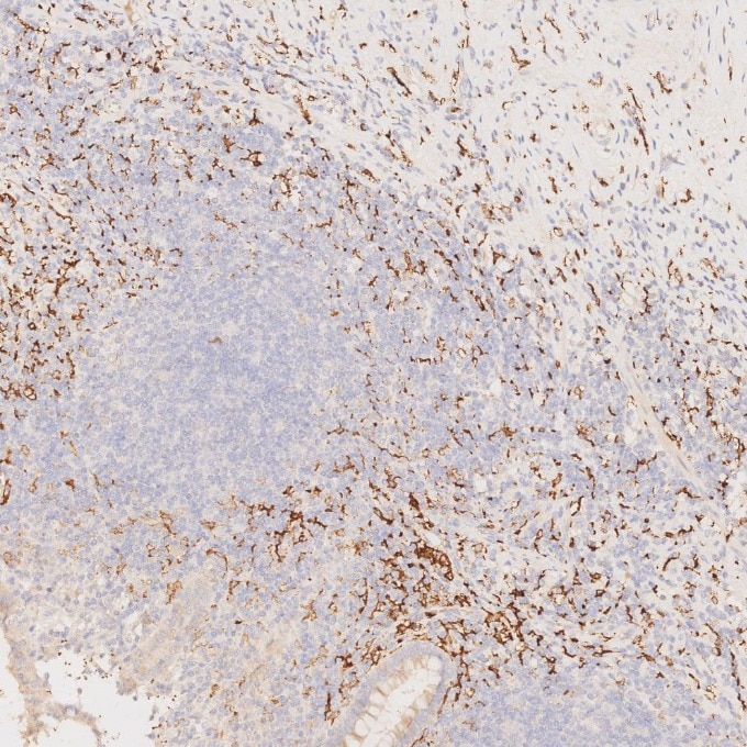IHC staining of human appendicitis using 68218-1-Ig Immunohistochemistry (IHC) staining of human appendicitis tissue using CD163 Monoclonal antibody (68218-1-Ig)