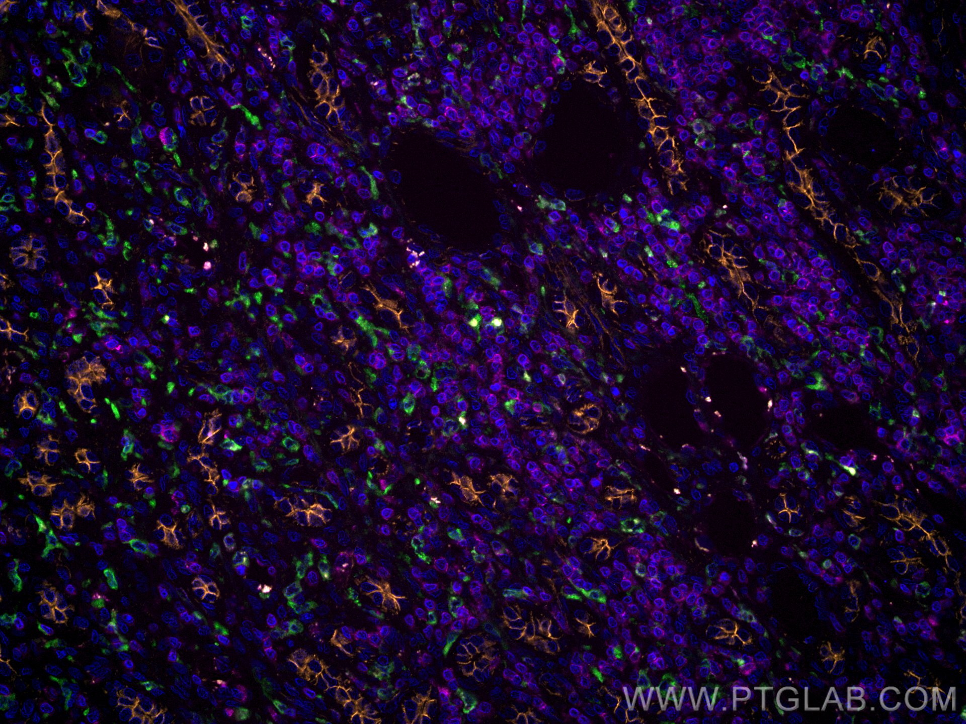 Immunofluorescence (IF) / fluorescent staining of human liver cancer tissue using CoraLite® Plus 488-conjugated CD163 Polyclonal ant (CL488-16646)