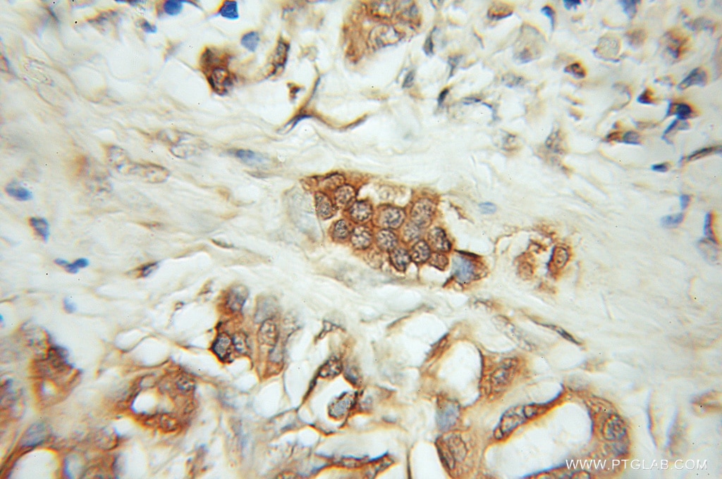 Immunohistochemistry (IHC) staining of human pancreas cancer tissue using CD164 Polyclonal antibody (12083-2-AP)