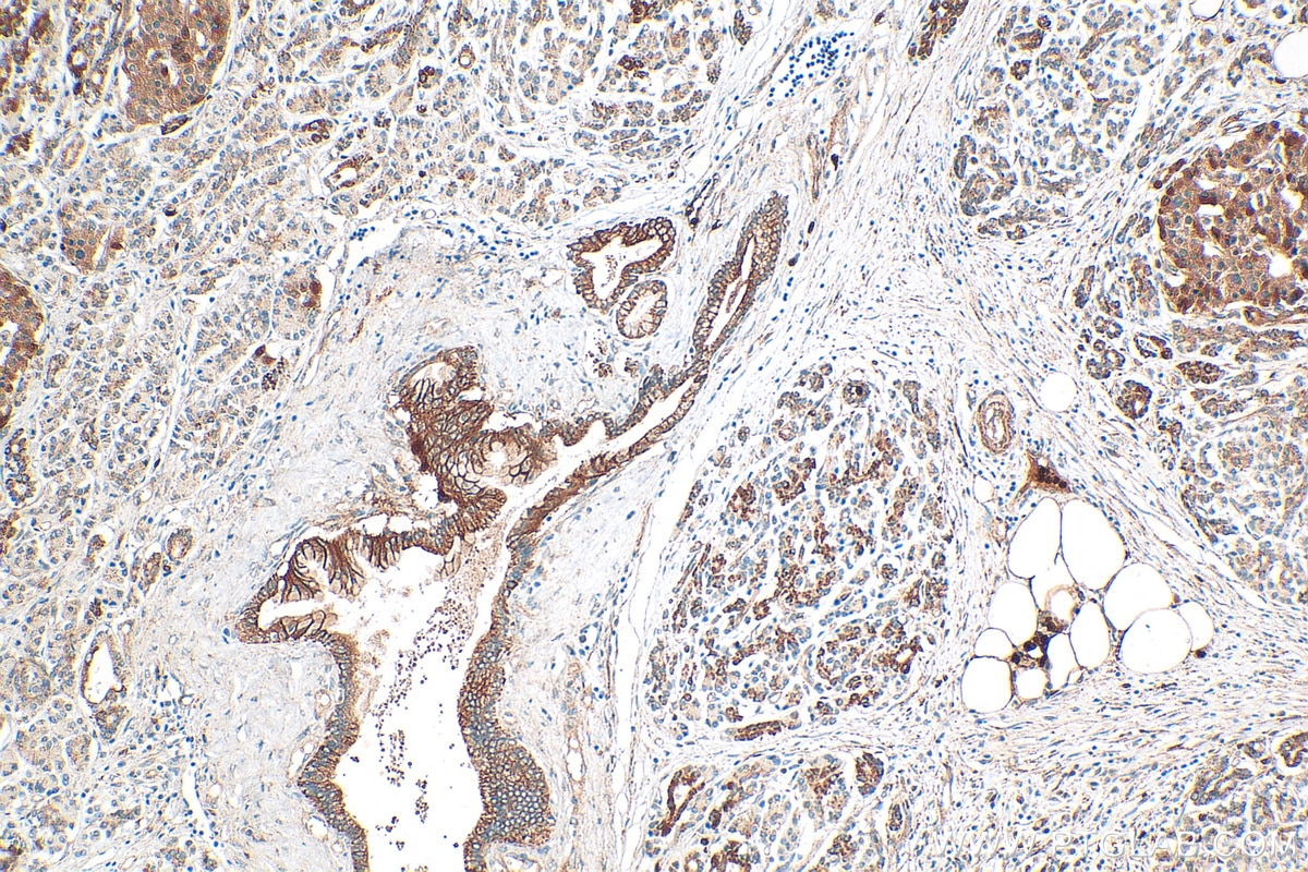 Immunohistochemistry (IHC) staining of human pancreas cancer tissue using CD164L2 Polyclonal antibody (25488-1-AP)