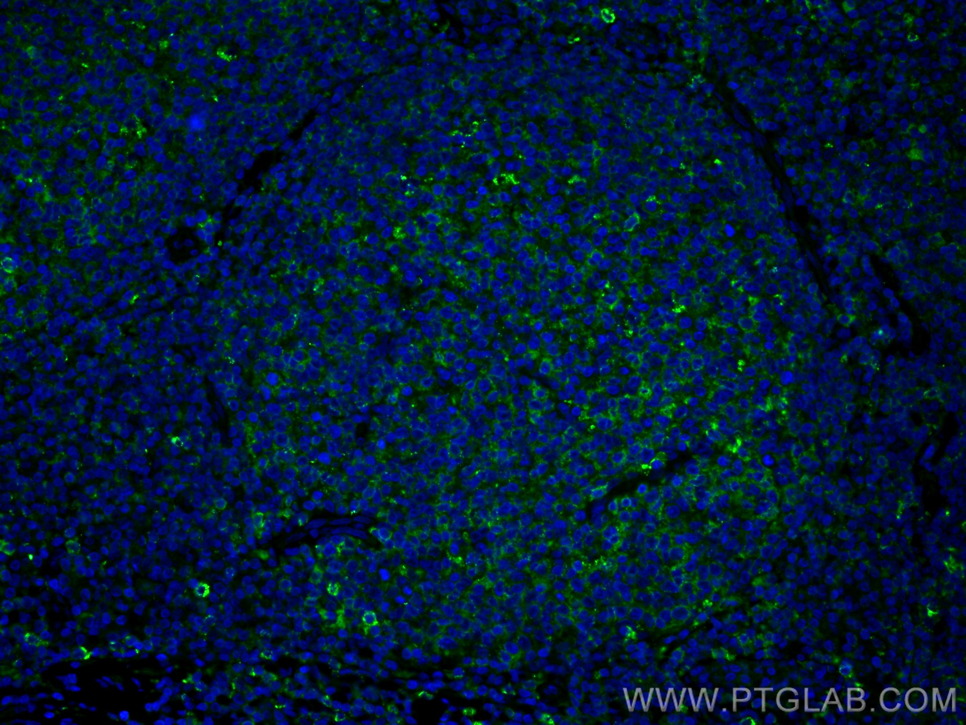 IF Staining of human tonsillitis using 55427-1-AP