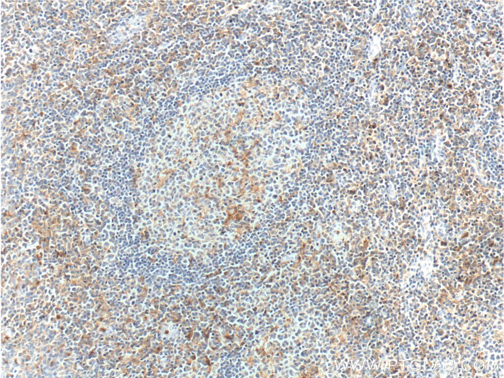 Immunohistochemistry (IHC) staining of human tonsillitis tissue using CD18 Polyclonal antibody (10554-1-AP)