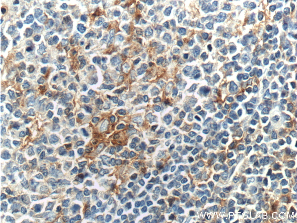 Immunohistochemistry (IHC) staining of human tonsillitis tissue using CD18 Polyclonal antibody (10554-1-AP)