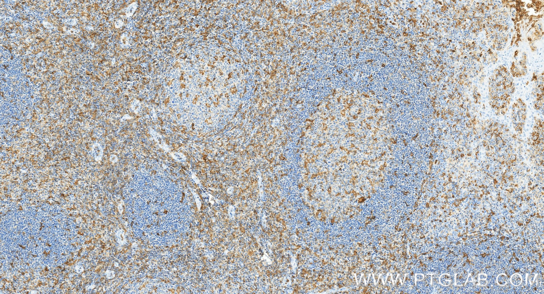 IHC staining of human tonsillitis using 87449-1-RR Immunohistochemistry (IHC) staining of human tonsillitis tissue using CD18 Recombinant monoclonal antibody (87449-1-RR)