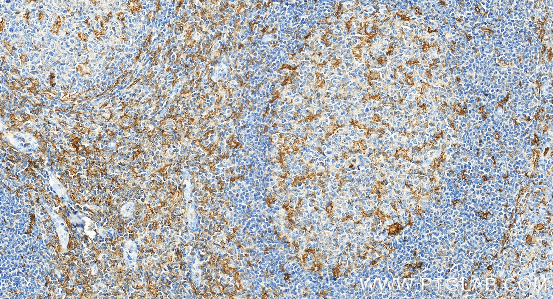 IHC staining of human tonsillitis using 87449-1-RR Immunohistochemistry (IHC) staining of human tonsillitis tissue using CD18 Recombinant monoclonal antibody (87449-1-RR)