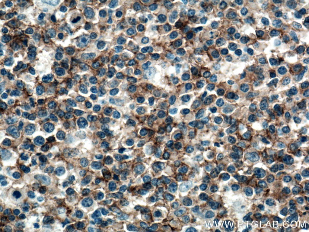 Immunohistochemistry (IHC) staining of human lymphoma tissue using CD19 Polyclonal antibody (27949-1-AP)