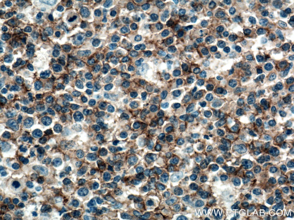 IHC staining of human lymphoma using 27949-1-AP