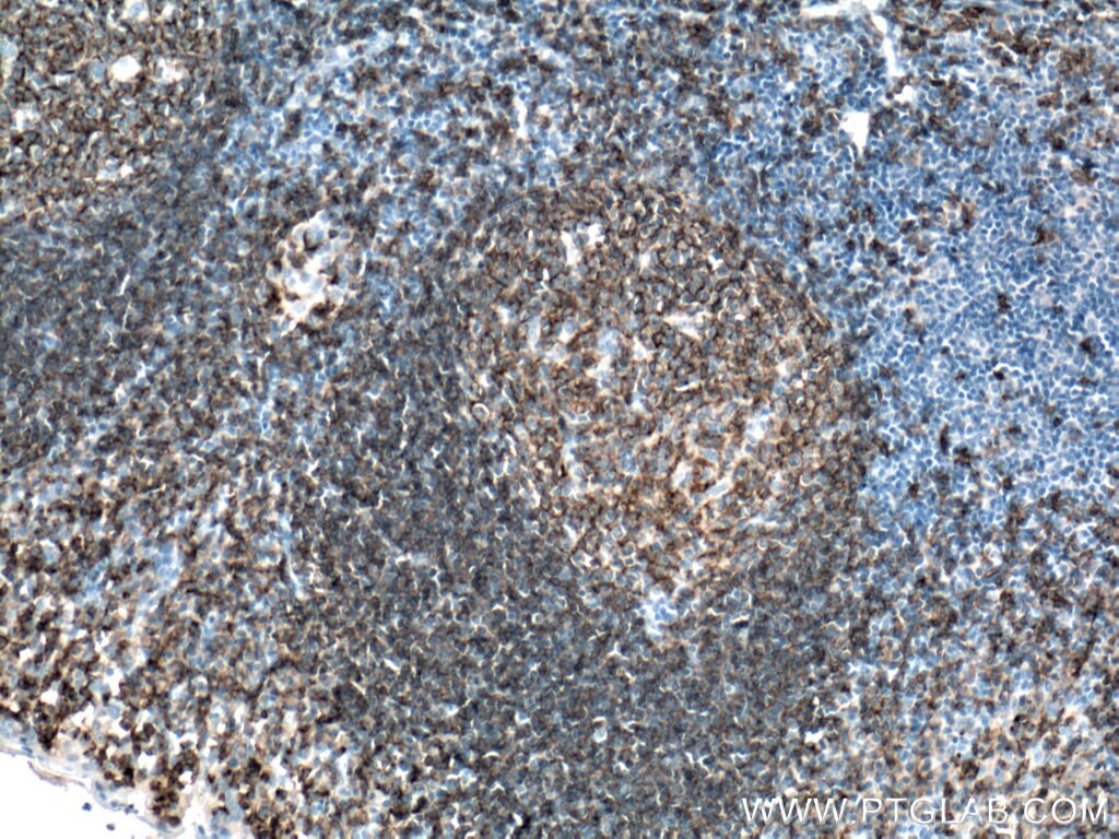 Immunohistochemistry (IHC) staining of human tonsillitis tissue using CD19 Polyclonal antibody (27949-1-AP)