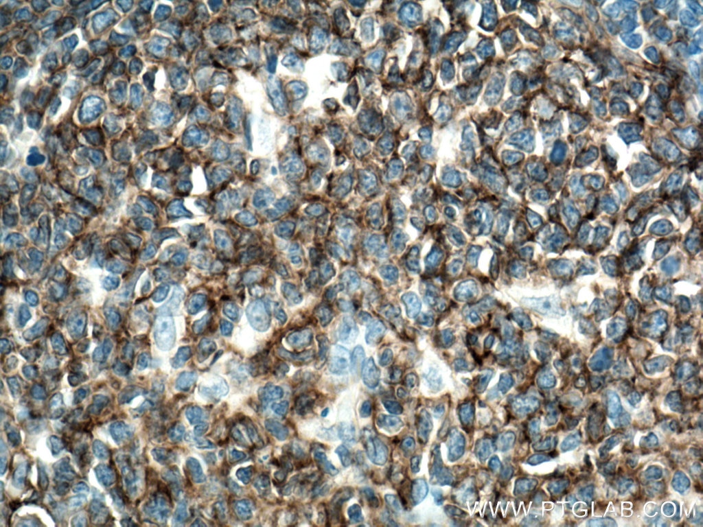 Immunohistochemistry (IHC) staining of human tonsillitis tissue using CD19 Polyclonal antibody (27949-1-AP)