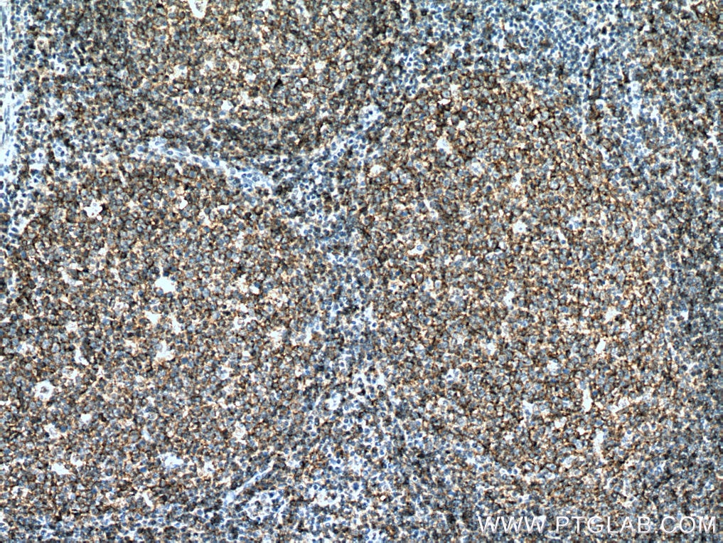 Immunohistochemistry (IHC) staining of human tonsillitis tissue using CD19 Monoclonal antibody (66298-1-Ig)