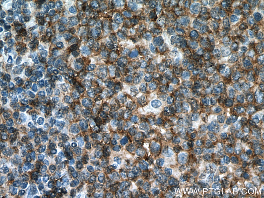 Immunohistochemistry (IHC) staining of human tonsillitis tissue using CD19 Monoclonal antibody (66298-1-Ig)