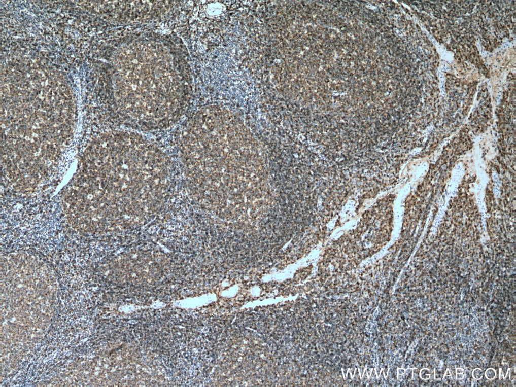 IHC staining of human tonsillitis using 66298-1-Ig