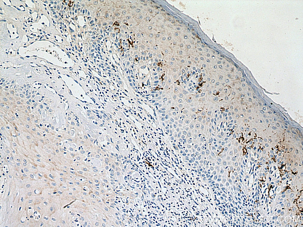 Immunohistochemistry (IHC) staining of human skin cancer tissue using CD1a Polyclonal antibody (17325-1-AP)