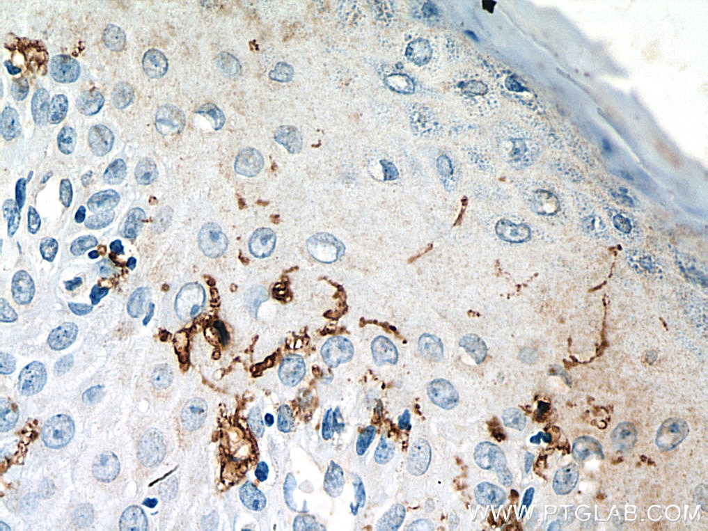 Immunohistochemistry (IHC) staining of human skin cancer tissue using CD1a Polyclonal antibody (17325-1-AP)