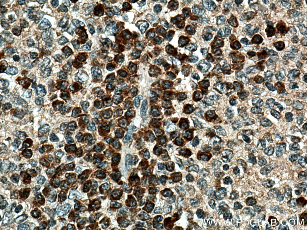 Immunohistochemistry (IHC) staining of human tonsillitis tissue using CD1c Polyclonal antibody (28838-1-AP)