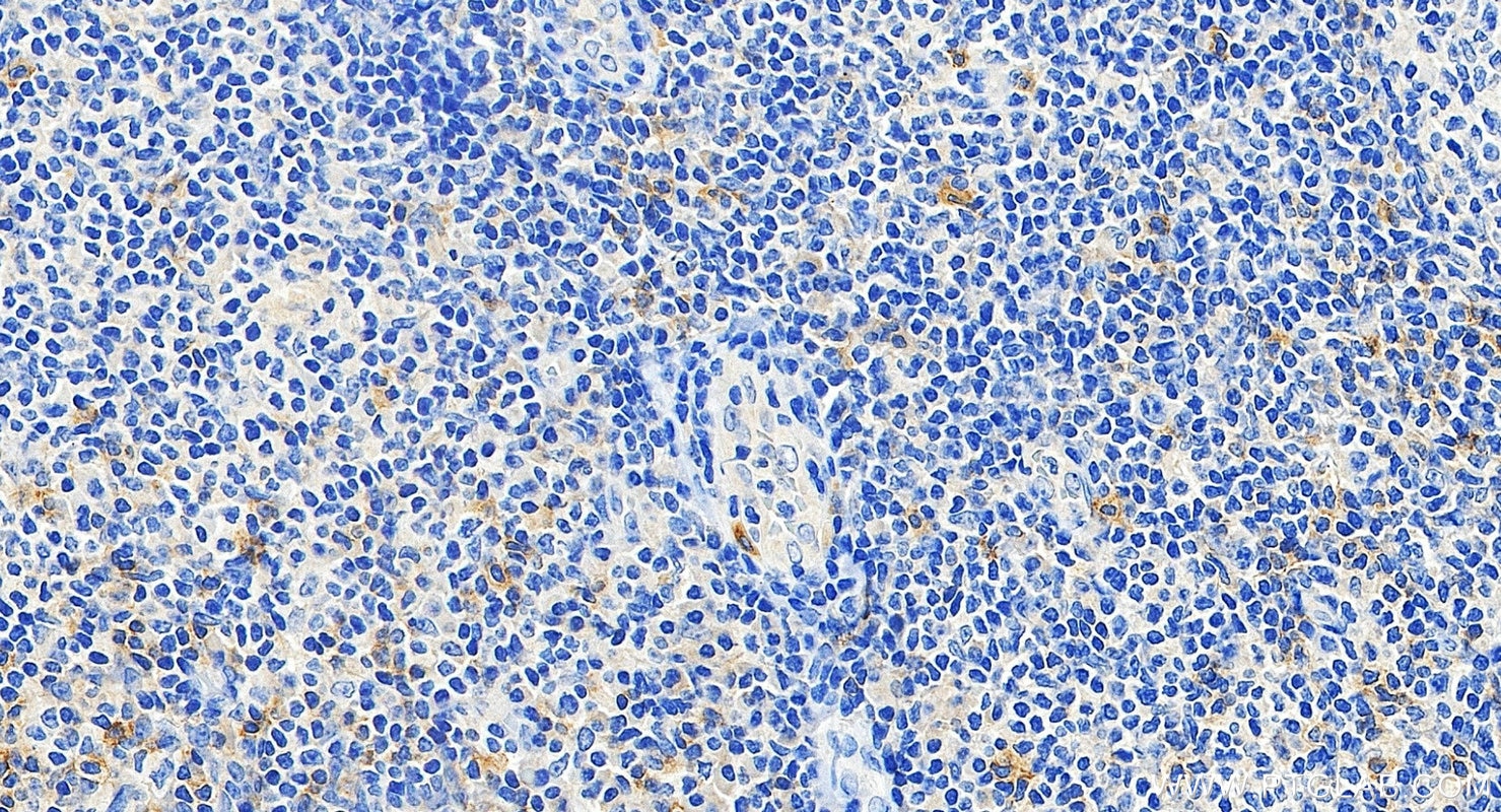 IHC staining of human tonsillitis using 87145-2-RR Immunohistochemistry (IHC) staining of human tonsillitis tissue using CD1c Recombinant monoclonal antibody (87145-2-RR)