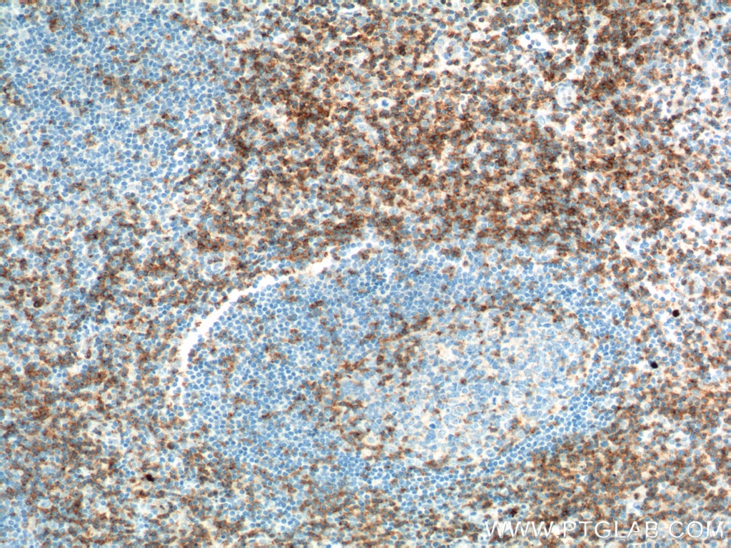 Immunohistochemistry (IHC) staining of human tonsillitis tissue using CD2 Polyclonal antibody (10299-1-AP)