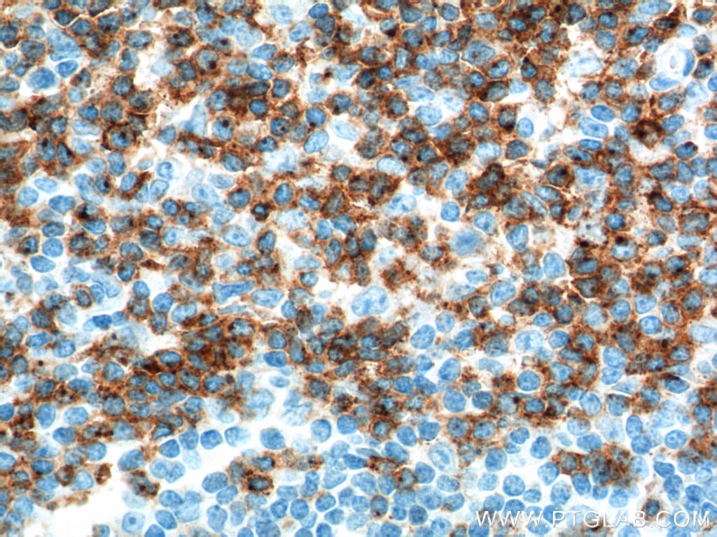 Immunohistochemistry (IHC) staining of human tonsillitis tissue using CD2 Polyclonal antibody (10299-1-AP)