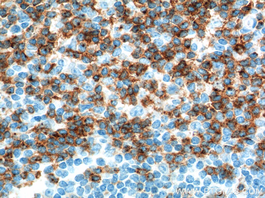 IHC staining of human tonsillitis using 10299-1-AP