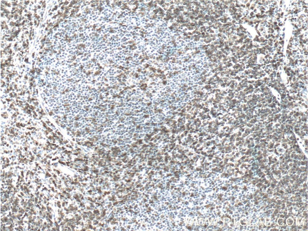 Immunohistochemistry (IHC) staining of human tonsillitis tissue using CD2 Polyclonal antibody (23973-1-AP)